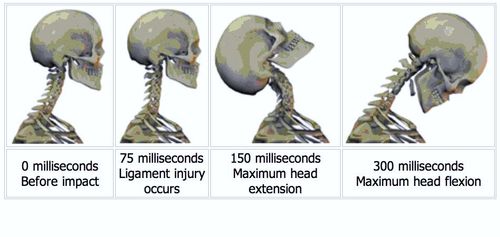Forms Of Treatment To Consider After A Whiplash Injury