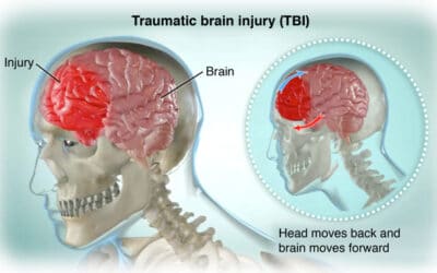 How Hope Health & Wellness can treat Traumatic Brain Injuries