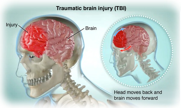 How Hope Health & Wellness can treat Traumatic Brain Injuries